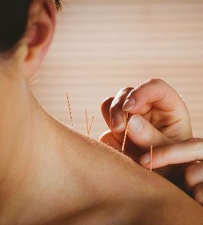 Shoulder acupuncture being applied to client in Canary Wharf