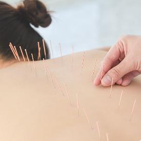 Acupuncture Treatment in Canary Wharf